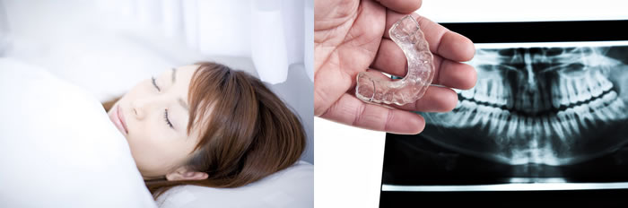 歯ぎしり・スポーツマウスピース