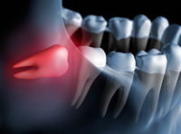 親知らずイメージ